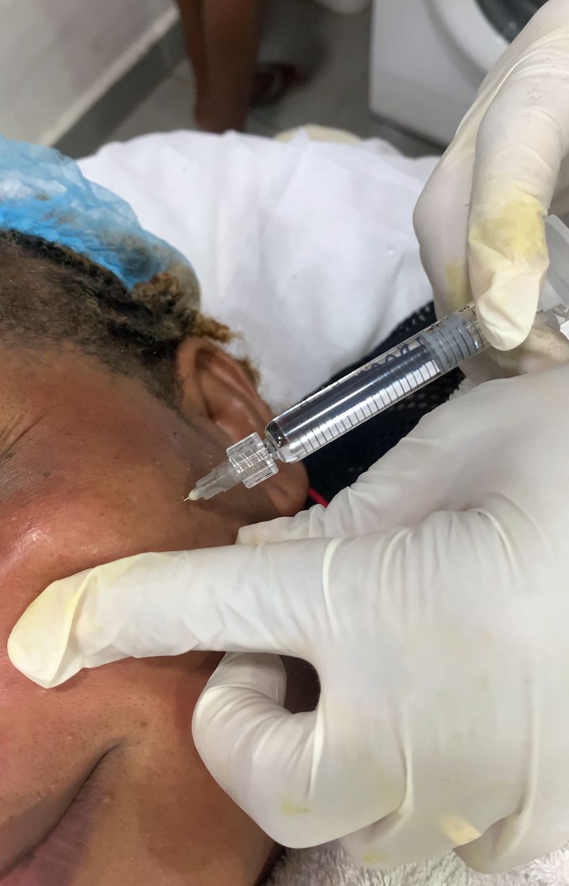 Micro-Needling Therapy