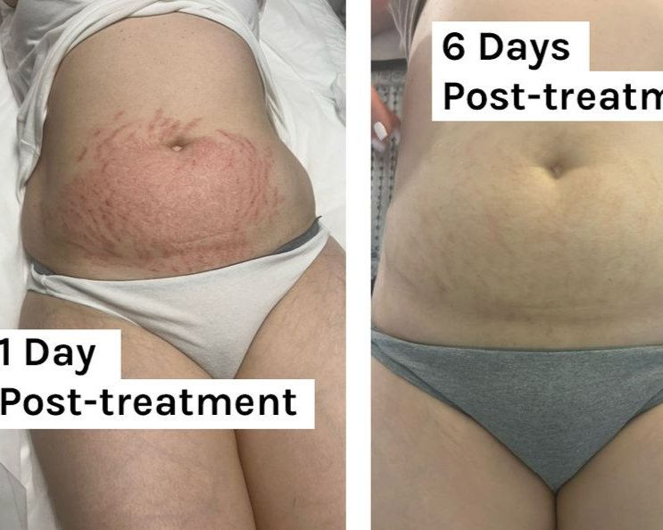 Stretch Mark Reduction