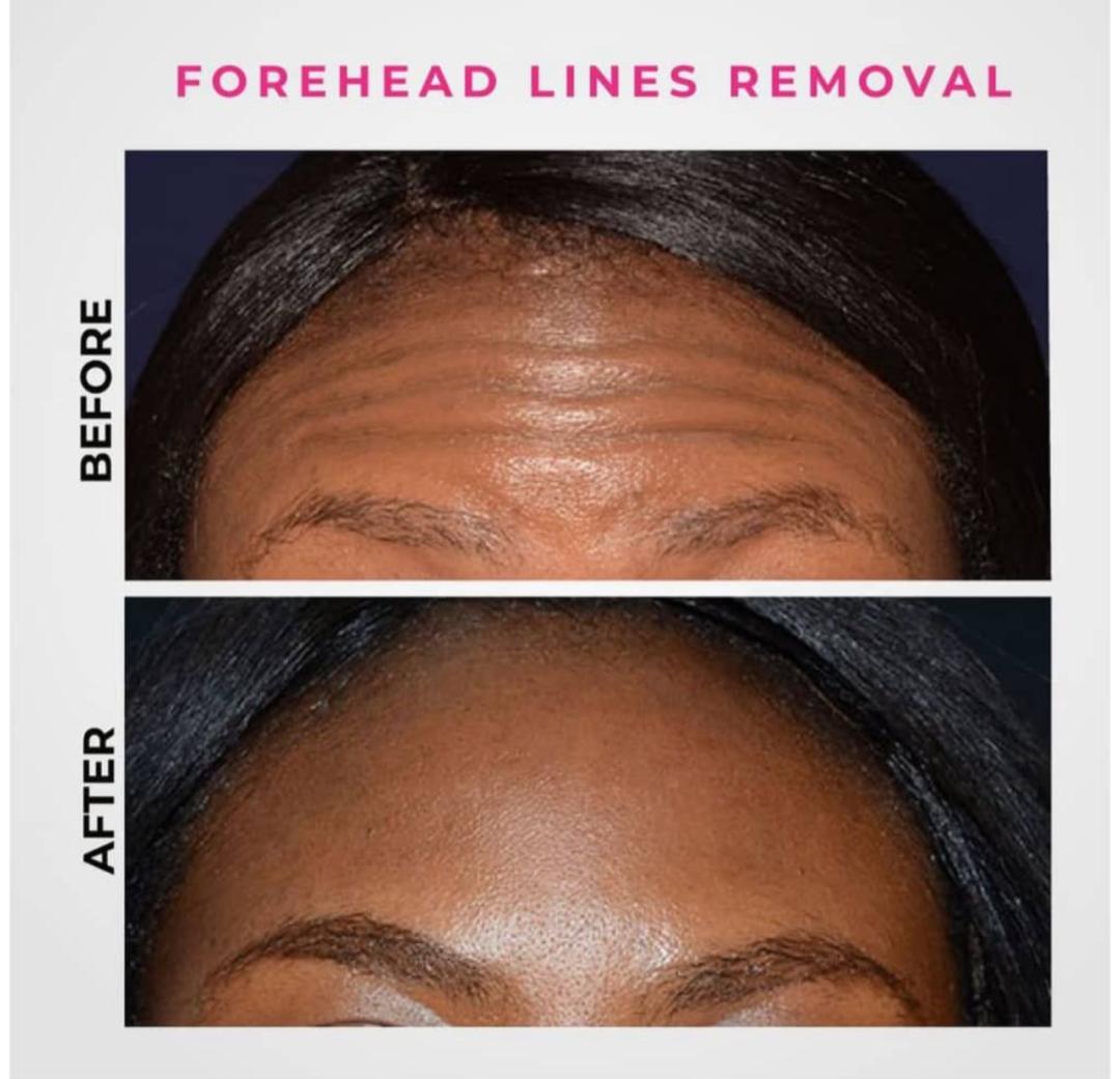 Botox & Skin Tightening Therapy