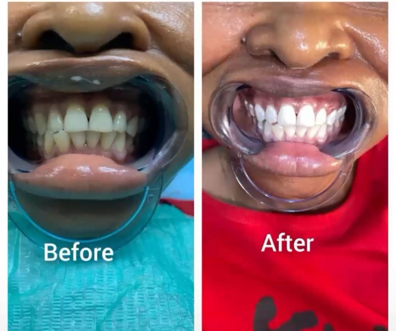Teeth Whitening & Scaling